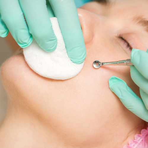 Acne Facial